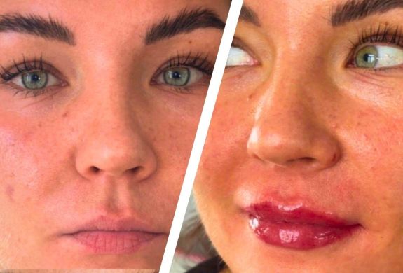 Split photo showing a before and after of a lip blush treatment